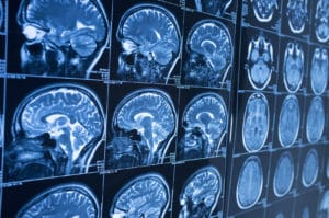 How M&Y Personal Injury Lawyers Can Help You Recover Compensation for a Brain Injury Caused from Toxic Exposure