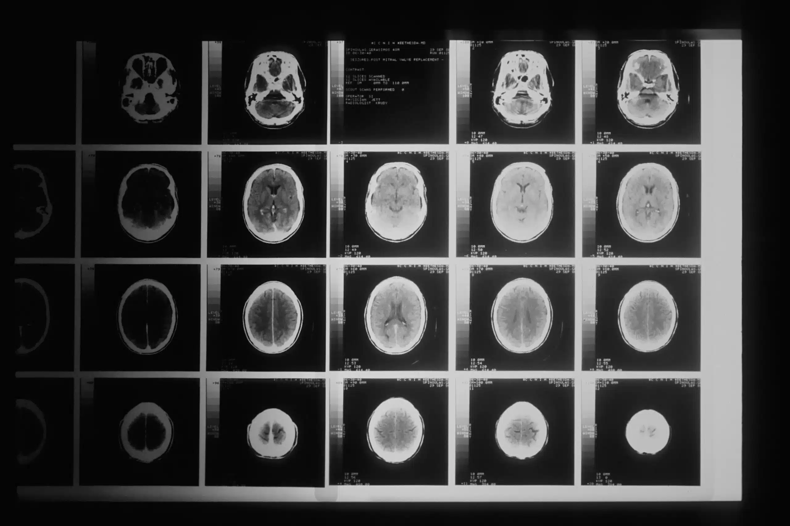 x-rays of a traumatic brain injury